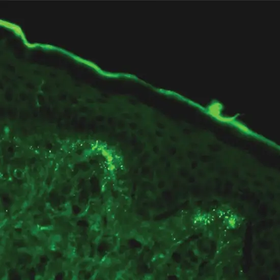 histopathology direct immunofluorescence skin biopsy igg